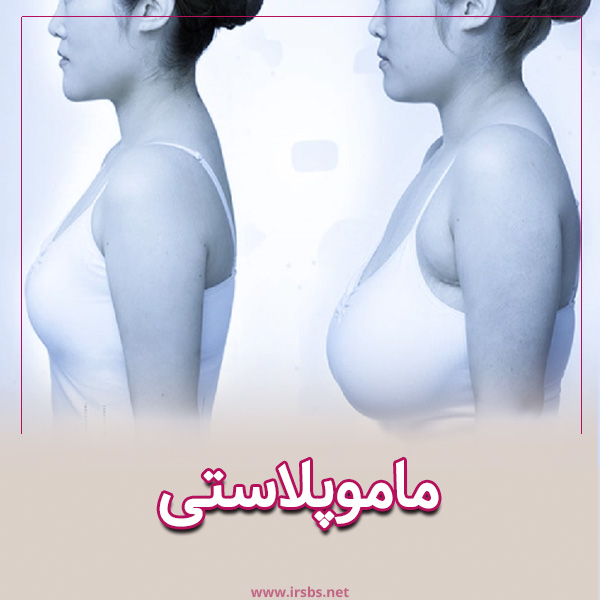 ماموپلاستی کاهشی