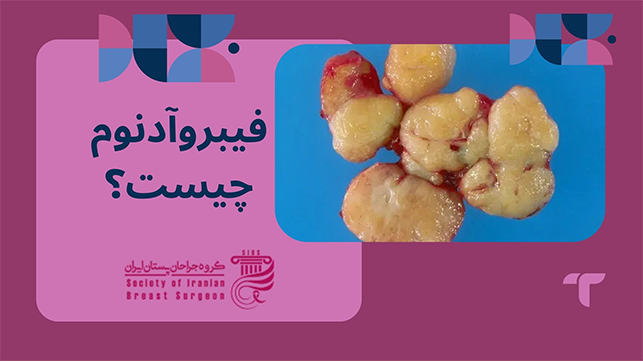 فیبروآدنوم چیست؟