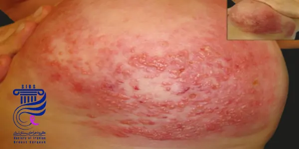 زوش های تشخیص سرطان سینه التهابی