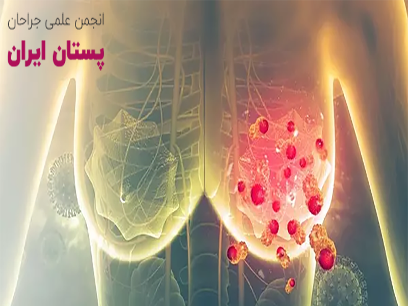 سرطان سینه