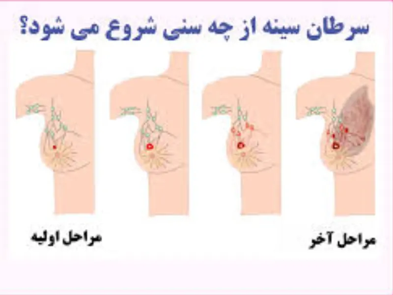 سن سرطان سینه