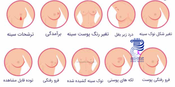 انواع سرطان سینه