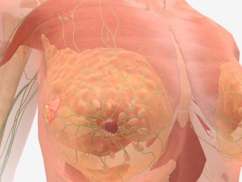 علائم سرطان سینه