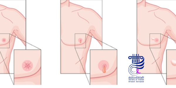 علائم سرطان سینه