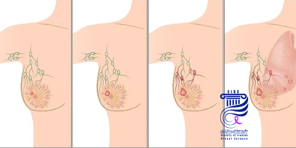 عمل سرطان سینه