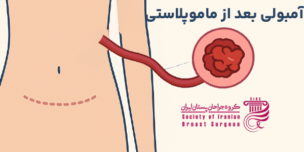 علت آمبولی بعد از ماموپلاستی