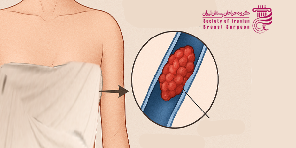 پیشگیری از آمبولی بعد از ماموپلاستی
