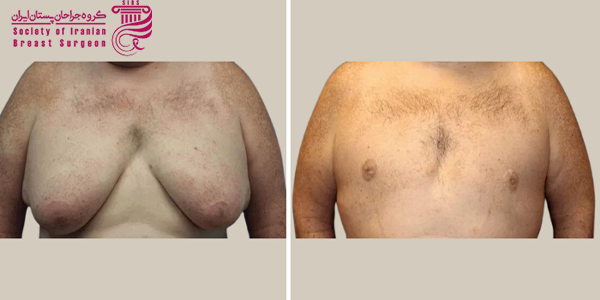 انواع عوارض ژنیکوماستی