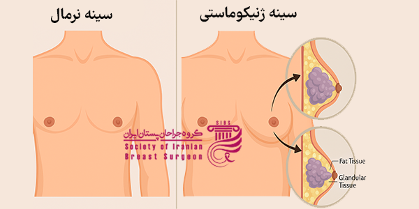 تفاوت سینه ژنیکوماستی با سینه عاذی
