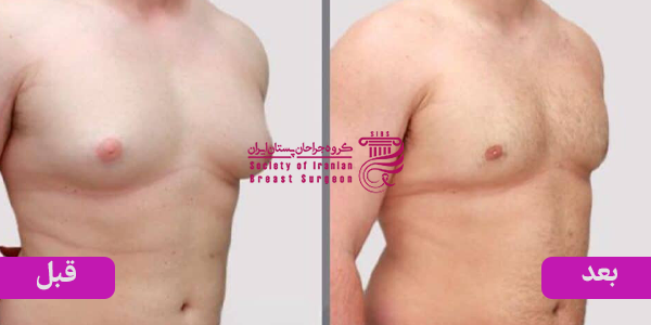 درمان ژنیکوماستی امکان پذیر است؟