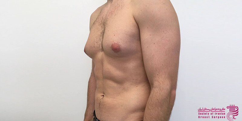 درمان ژنیکوماستی