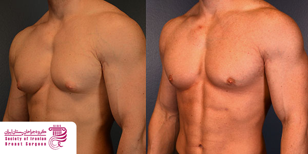 دوره نقاهت بعد از ژنیکوماستی