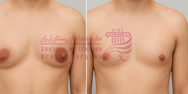 علت ایجاد ژنیکوماستی چیست