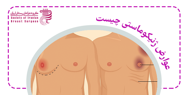 عوارض ژنیکوماستی چیست