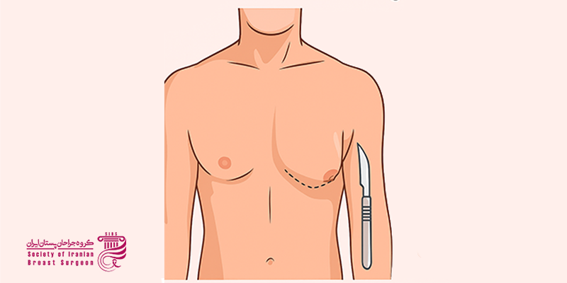عوارض ژنیکوماستی