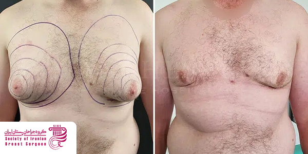 نحوه مراقبت بعد از ژنیکوماستی