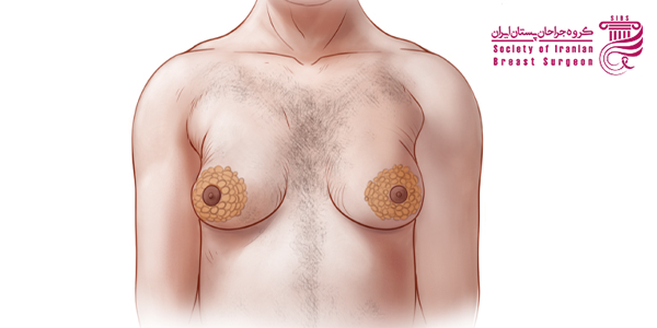 هزینه ژنیکوماستی در سال 1404